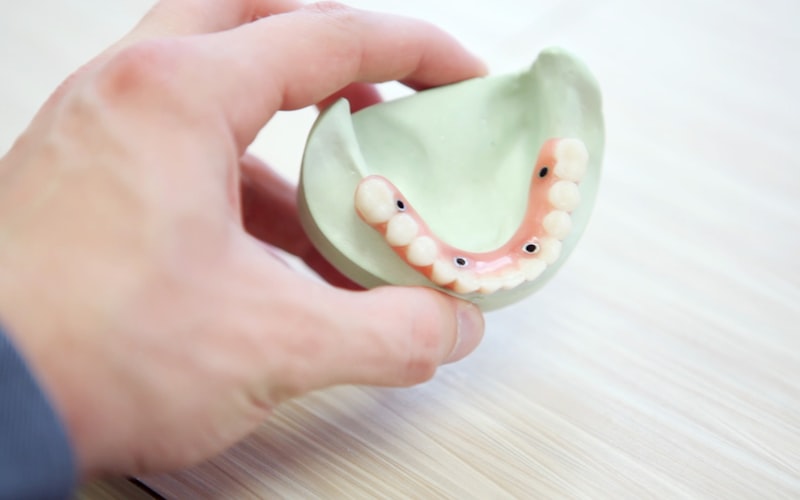Dental implant bridge prosthesis - implant crowns in Ottawa