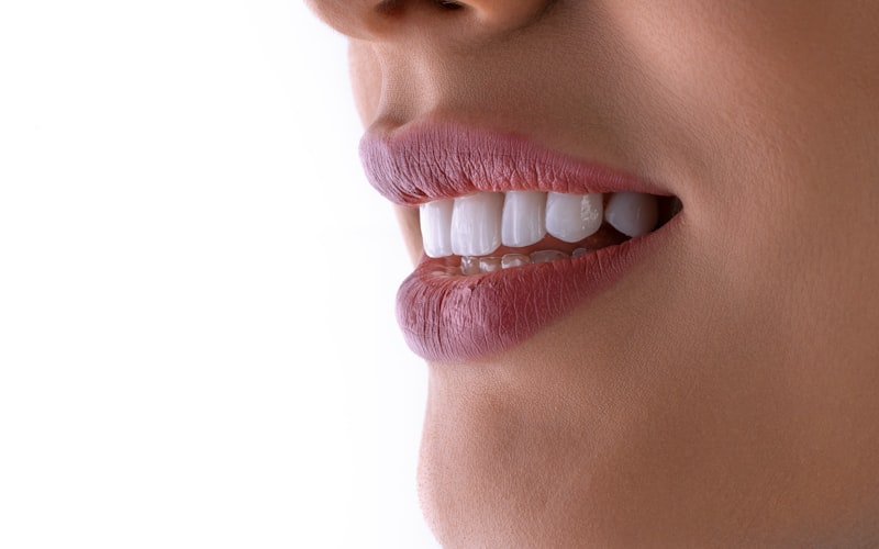 Bright white teeth after professional whitening at Whitehaven Dental Ottawa